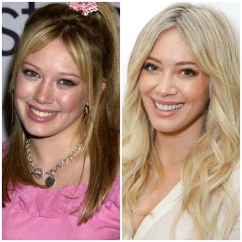 A Look At Hilary Duff’s History With Plastic Surgery